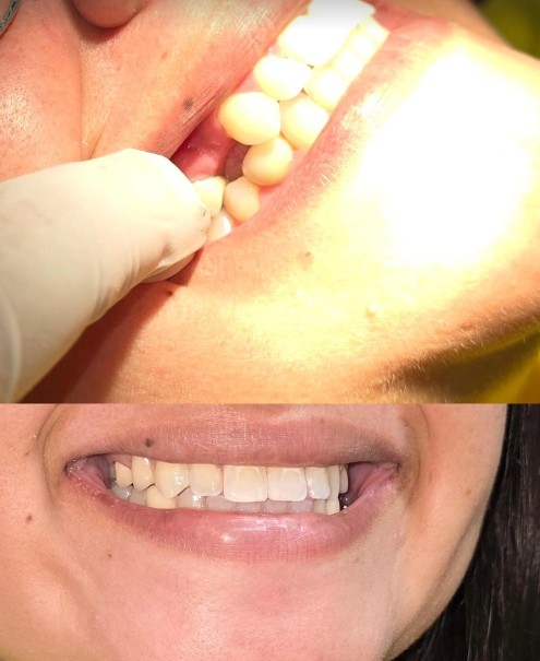Antes e depois — caso 1